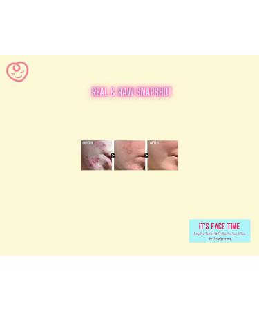 3-Step Acne Care Kit for Kids Pre-Teens & Teens - Cleanser Toner & Treatment for Clear Skin - Buy Online on GoSupps.com