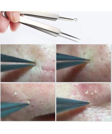 Narutosak Blackhead Acne Clip Curved Pimple Extractor Tweezer Tool - Remover for Comedones - Buy Online on GoSupps.com