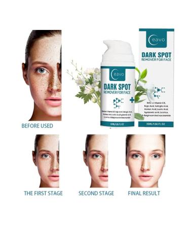 Dark Spot Remover Serum for Face with Vitamin C, Retinol, Salicylic Acid & More - Hyperpigmentation & Acne Scar Treatment - Buy Online on GoSupps.com