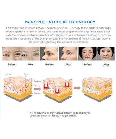 fractional tightening device rejuvenation lifting - Buy Online on GoSupps.com