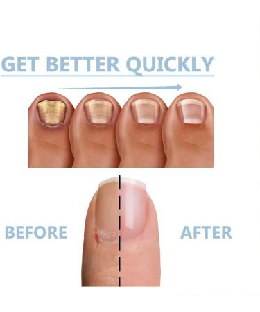 HOPASRISEE Onyxoguard Nail Growth and Repair Serum Onyxoguard Serum Nail Strengthener Nail Growth Serum Nail Growth and Strengthener Nail Serum for Strength and Growth (3) - Buy Online on GoSupps.com