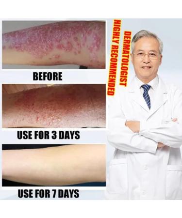 Raipult Eczema Itching Skin Health Spray - Skin Eczema Relief Treatment - Buy Online on GoSupps.com