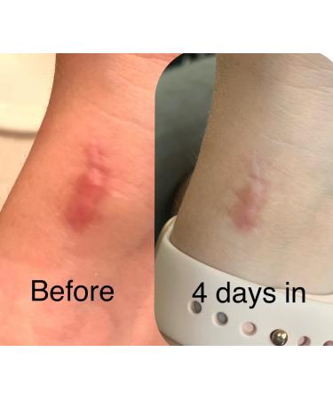 Sialicess Reusable Silicone Scar Strips for Keloid & Hypertrophic Scars - 2 Month Supply - 4 PCS - Buy Online on GoSupps.com