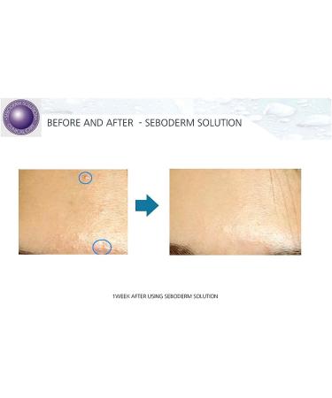 Buy Acne Seboderm Solution - Anti Sebum Treatment for Blemish-Prone Skin | Pore Shrinking Care Worldwide Shipping - Buy Online on GoSupps.com