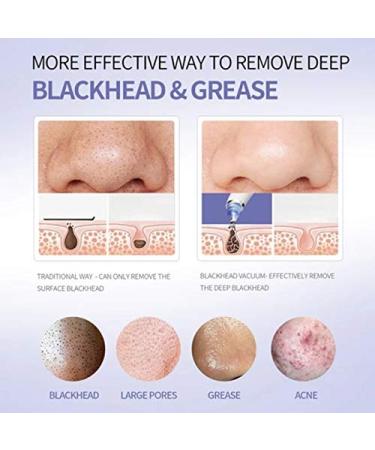 DermaSuction 4-in-1 Blackhead Whitehead Extractor for Men and Women - Multi-function Remover Device - Buy Online on GoSupps.com