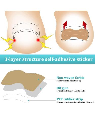 200 Pieces Ingrown Toenails Stickers Toenail Correction Patch Glue-Free Ingrown Curved Toenail Lifter Foot Care Treatment Pedicure Tool (A) - Buy Online on GoSupps.com