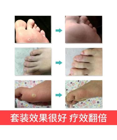 Ji yan Tie/Yat Tip Tor Corn & Callus Removing Plaster - 12 Plasters | Effective Corn & Callus Removal - Buy Online on GoSupps.com