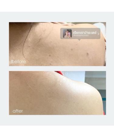 Oxe-cure Body Acne Spray 50 ml - Buy Online on GoSupps.com