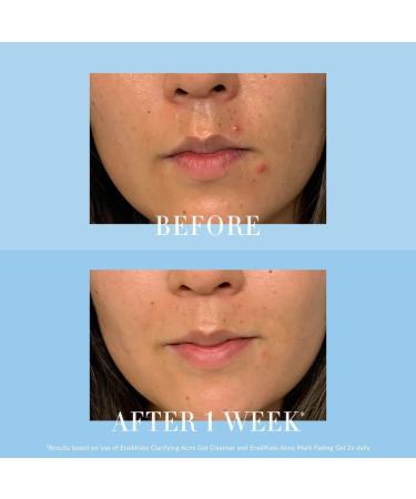 Kate Somerville EradiKate Clarifying Acne Gel Cleanser - 4 Fl Oz - Buy Online on GoSupps.com