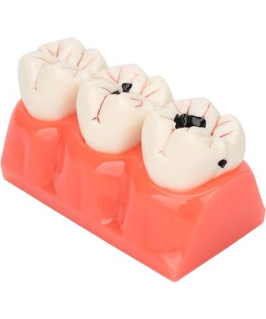 Verdant Touch Simulation Teeth Caries Model - Removable Tooth Caries Demonstration for Dental Education | International Shipping - Buy Online on GoSupps.com