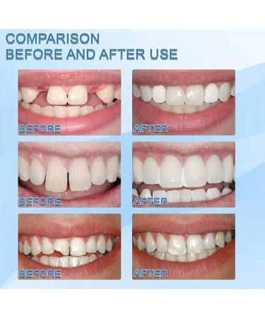  Anshka Tooth Repair Beads for Everyone Temporary Tooth Repair Kit Thermal Beads for Filling Fix the Missing and Broken Tooth Restore a Confident Smile 30ml1pcs - Buy Online on GoSupps.com