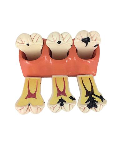 4 -times caries teeth disassembling model dental model brushing tooth floss practice tooth sloper evolutionary instruments for teaching and learning