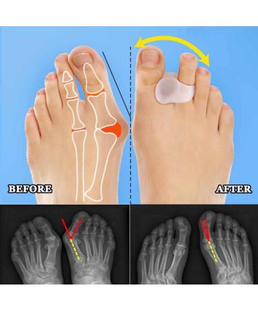 Gel Toe Separators 8 Pack - Toe Corrector & Spacer for Bunions, Hammer Toes, Overlapping Toes - Hallux Valgus Relief - Clear - Buy Online on GoSupps.com