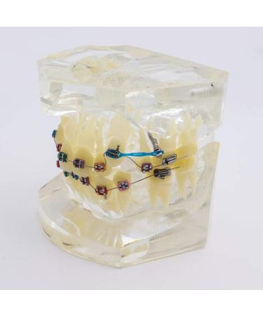 Dental Orthodontic Model Oral Cluttered Teeth Pattern with Ceramic Supports for Studying The Anti-jaw Protrusion Opening of The jaw - Buy Online on GoSupps.com