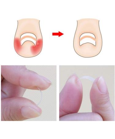 Toenail Tool 6 in 1 Ingrown Toe Nail Fixer Pedicure Toenail Recover Nail Foot Care Kit Ingrown Toenail Corrector for Men Women(24pcs) - Buy Online on GoSupps.com