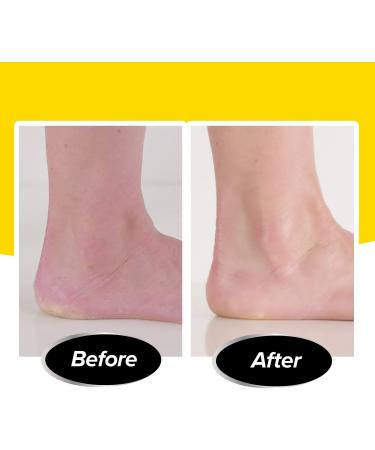 PediVac Electric Callus Remover with Built-In Vacuum - New Look | Removes Calluses & Dry Skin in Seconds | Mess-Free | 2000 RPMs | LED Light | 2 Speed Settings - Buy Online on GoSupps.com