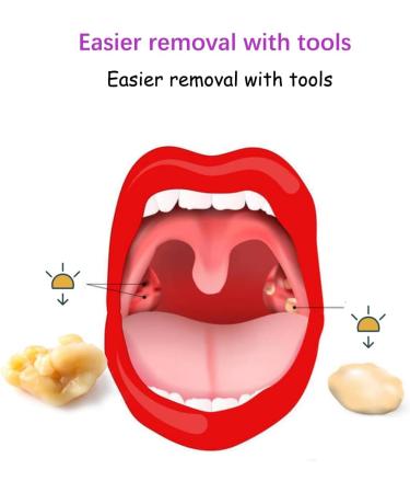 Tonsil Stone Removal Kit - Professional Stainless Steel Tools for Easy Oral Care & Relief - Buy Online on GoSupps.com