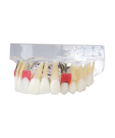 Dental Upper Implantate Model - Upper Overdenture Restoration Model - With superior teeth demo transparent vision soft gum implant nail for education and study model (a)