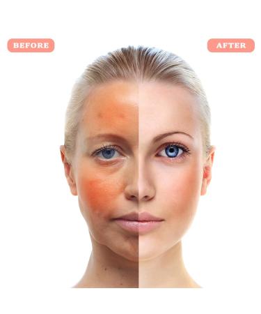 PrettyCare Pink Ice Roller for Face and Eye - Relief from Puffiness, Migraine, Pain & Minor Injuries - Summer Cooling Skin Care Product - Buy Online on GoSupps.com