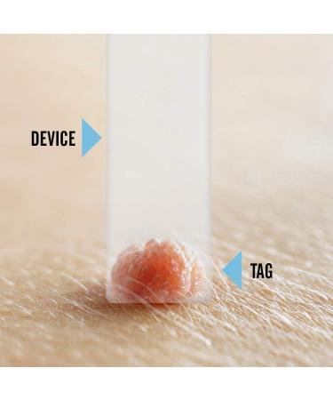 Tagcure Skin Tags Remover Kit - Easy Wart Mole & Skin Tag Removal at Home - Micro Device + Oil - Suitable for Skin Tags 0.5cm or Less - Buy Online on GoSupps.com