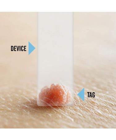 Tagcure Skin Tag Removal Kit - Easy & Effective Skin Tag Remover with Tape Refill - Fast International Shipping - Buy Online on GoSupps.com