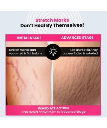 Thrive.Co Stretch Marks Expert Serum Cream | Remove Red & White Stretch Marks | Hydrating Formula with Striover Rosehip Oil & Squalane | Unisex | 30ml - Buy Online on GoSupps.com