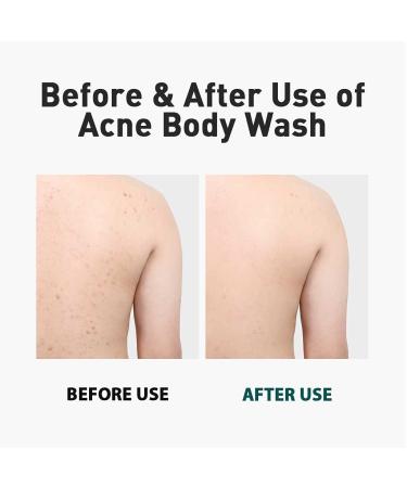 Dashu Daily Acne Relax Body Wash 16.9fl oz - Cooling Acne Treatment - Buy Online on GoSupps.com