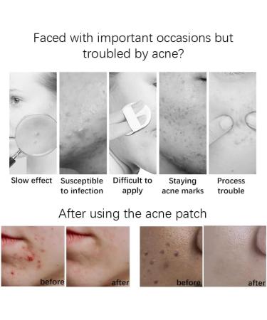 AYNKH 116 Patches LitBear Acne Patches for Face Chin or Body Acne Spot Treatment with Tea Tree and Calendula Oil for Large Zit Breakouts For Day and Night Use (with 1 Pc Acne Blemish Needle) - Buy Online on GoSupps.com