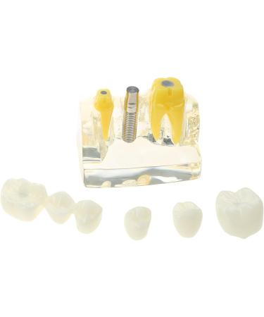 Implant Model Removable Bridge - Educational Teeth Model for Dental Studies | Perfect for Demonstration Classes - Buy Online on GoSupps.com