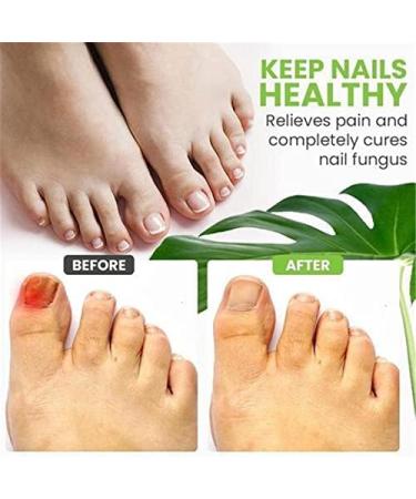 JFGO TOE Be Health 7 Days Treatment Gel & Efero Nail Repair Essence Gel - Instant Toenail Treatment & Cure | Nail Repair Cream (2PC) for Healthy Nails - Buy Online on GoSupps.com