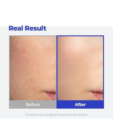 SKINSINS Pair Acne Cream for Face 24g (0.85 fl oz) Made in Japan - Buy Online on GoSupps.com