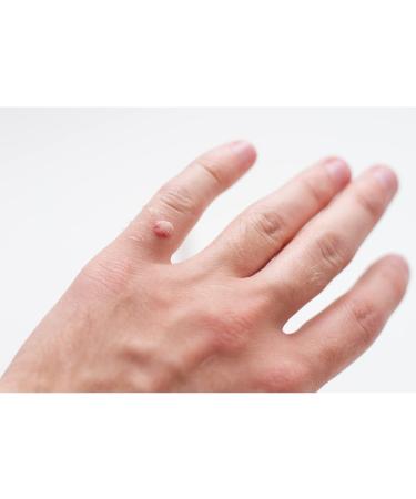 Fast Acting Gel Wart Remover Freeze Off | Effective Wart Removal for Plantar Genital Common & Flat Warts | Quick Relief & Healing - Buy Online on GoSupps.com