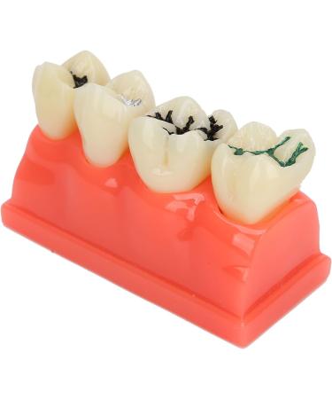 Ververt Touch Tooth Model - 180mm Dental Caries Demonstration Model for Schools & Dentists | Learning Aid for Dental Lessons - Buy Online on GoSupps.com