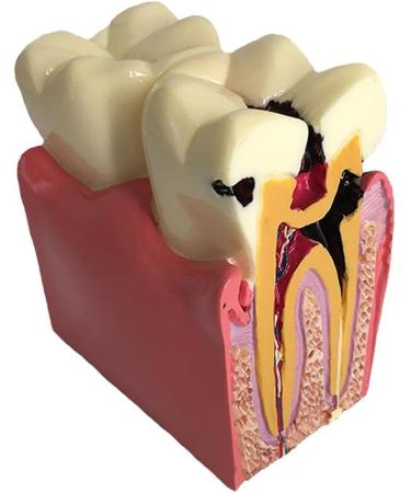 Colcolo Teeth Model - 6X Caries Comparison Examination Models for Study & Research | International Shipping Available - Buy Online on GoSupps.com