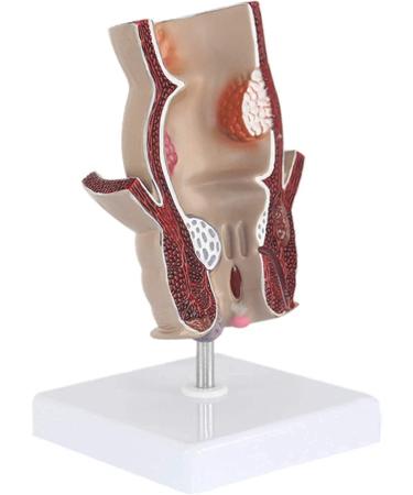 Medical Science Rectum Fissure Lesion Model 5X Human Pathology Model Hemorrhoid Anal Fistula Medical Organ Model - Buy Online on GoSupps.com