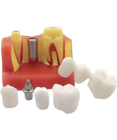 4x Dental Implant Teeth Model with Removable Crown - Crown & Bridge Dentist Training Tool for Patient Analysis | International Shipping - Buy Online on GoSupps.com