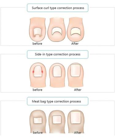 CheeseandU 2022 Ingrown Toenail Stickers 10-Pack - Glue-Free Toe Nail Patch for Painless Correction - Men & Women Toenail Care - Buy Online on GoSupps.com