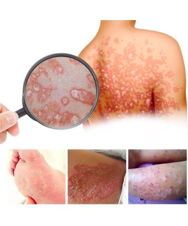 Max Strength Antifungal & Psoriasis Cream 20g - Fast Relief for Tinea Itch Rash & Redness. Intensive Healing Ointment (1-Bottle Pack for mild Care 3-Bottle Pack Recommended) - Buy Online on GoSupps.com