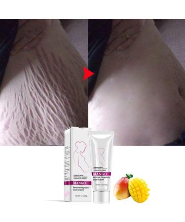 Best Stretch Mark Cream for Pregnancy & Postpartum - Repair & Remove Scars - Buy Online on GoSupps.com