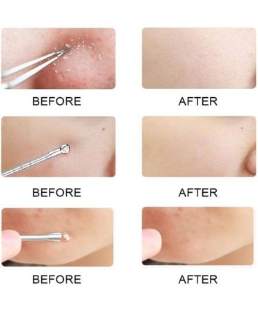 KAV Comedone Extractor Kit 5-Piece Blackhead Remover Tool Set with Storage Case for Acne Prone Skin - Stainless Steel Pimple and Blemish Extractor Tools for Deep Cleansing - Buy Online on GoSupps.com
