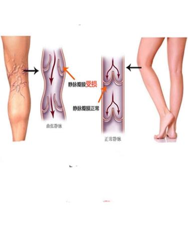 EGURS Compression Stockings for Women & Men | 34-46mmHg Class 3 Support Socks for Pregnancy Sports Flight & Anti-Thrombosis - Medical Grade - Buy Online on GoSupps.com