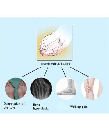 JHGCCL Thumb Eversion Bunion Corrector Night Use 1 Pair - Toe Separators for Overlapping Toes - Buy Online on GoSupps.com