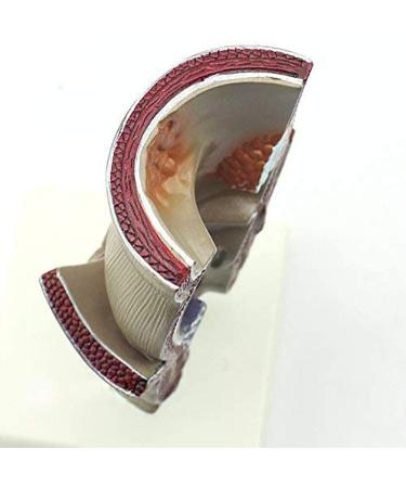 ZCBYBT Hemorrhoid Injury Model Human Rectal Pathology Model Internal and External Hemorrhoids Model Anus Model Suitable for Educational Use - Buy Online on GoSupps.com