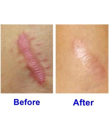 Buy Hirudoid Cream 20g - Advanced Scar Treatment | International Shipping Available - Buy Online on GoSupps.com