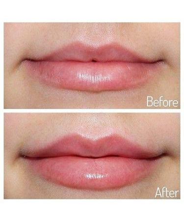 Fillerina Lip Plump Treatment | Hyaluronic Acid | Up to 3 Months Plumping Effect - Buy Online on GoSupps.com