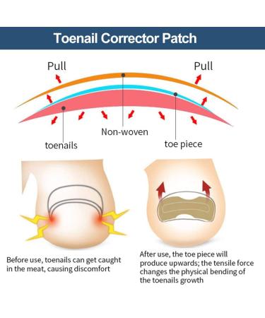 60 Pcs Toenail Correction Patch | Ingrown Toenail Treatment & Repair Stickers | Pain Relief & Easy Application - Buy Online on GoSupps.com