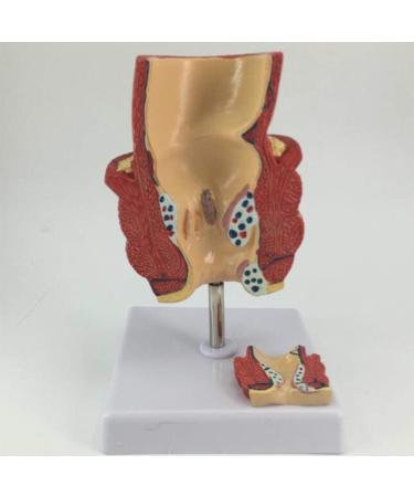 YOtat Human Pathological Hemorrhoids Model-Colorectal Hemorrhoid Lesion Model-Placed On The Base-is The Best Teaching Aid for Doctor-Patient Communication - Buy Online on GoSupps.com