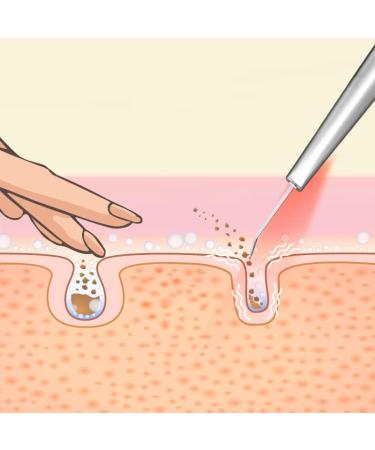 Lumineo Ultrasound Peeling Device - 4-in-1 Skin Scrubber Blackhead Remover EMS LED & Ions with 400ml Moisturizing Toner | Best Acne & Pore Cleaner - Buy Online on GoSupps.com