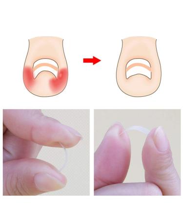Ingrown Toenail Corrector Strips - 10pcs Bottle, Straightener Clip for Thick Toenails - Foot Tool for Correction - Buy Online on GoSupps.com