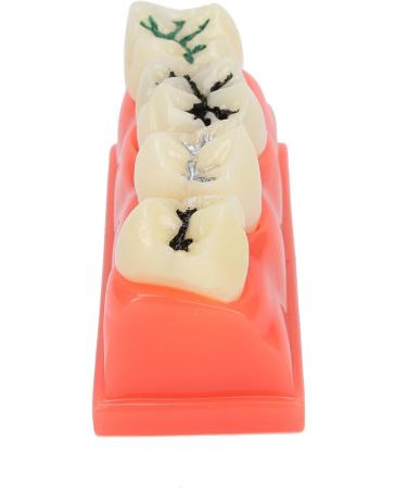 Ververt Touch Tooth Model - 180mm Dental Caries Demonstration Model for Schools & Dentists | Learning Aid for Dental Lessons - Buy Online on GoSupps.com